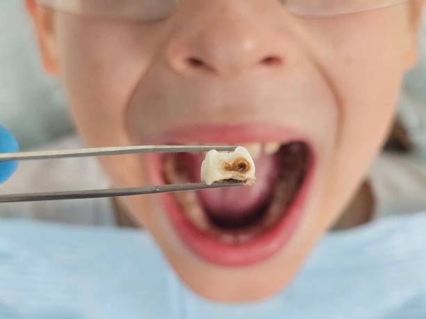 Best Emergency Dental Extractions in Clarksville, TX